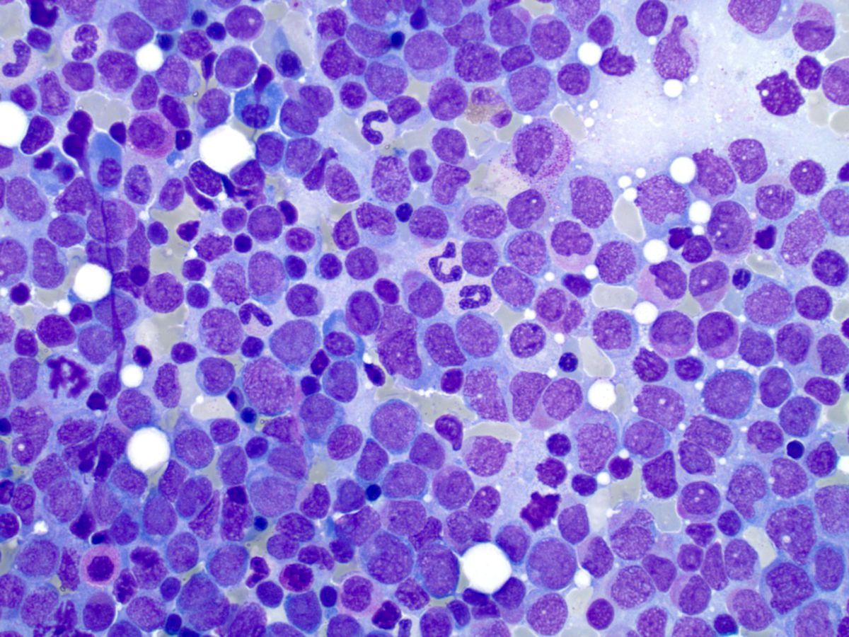 Bone marrow aspirate smear (500X) showing increased blasts